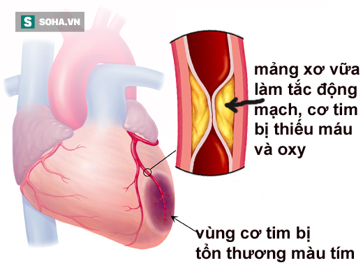 Bệnh nhồi máu cơ tim: Những cái chết không được báo trước - Ảnh 1.