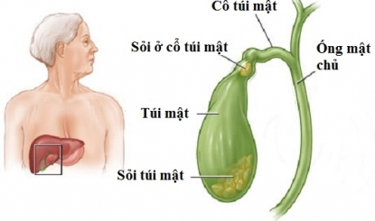 Những dấu hiệu nhận biết bệnh sỏi mật sớm nhất ai cũng phải nhớ - Ảnh 1.