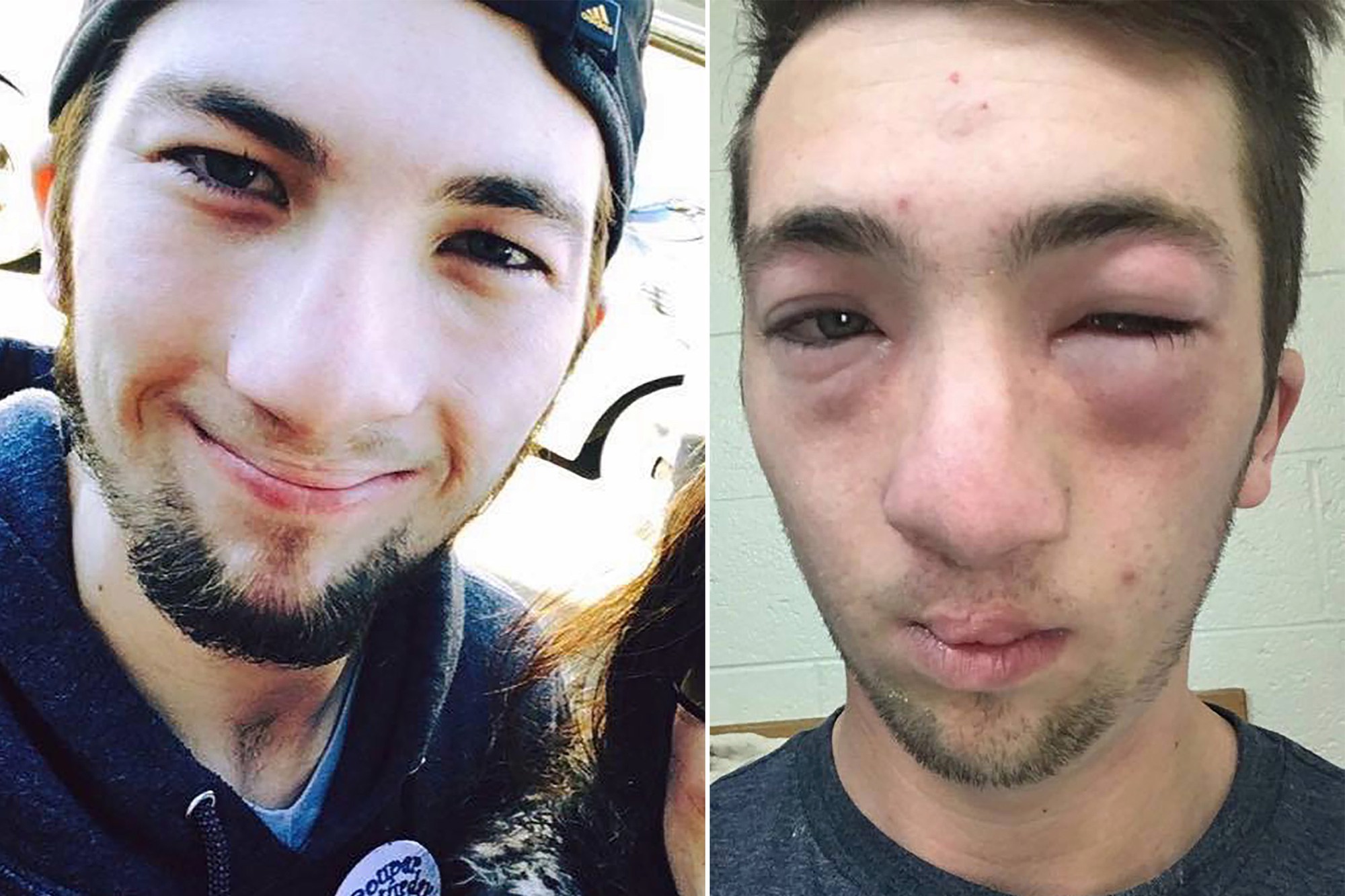 Hạt đậu phộng ngon lành là thế, nhưng nhiều người có thể chết do dị ứng nó - Ảnh 3. Hạt đậu phộng ngon lành là thế, nhưng nhiều người có thể chết do dị ứng nó - Ảnh 3.