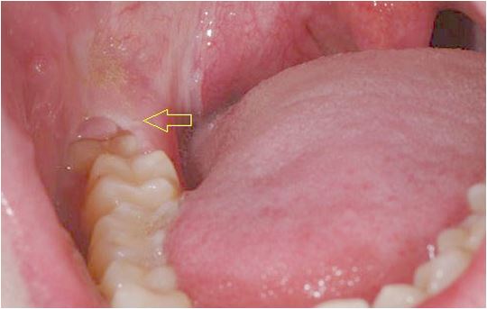 Ai cũng có chiếc răng nguy hiểm: Người khốn đốn, kẻ suýt tử vong vì điều trị không đúng - Ảnh 2.