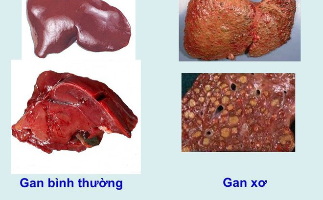 Dấu hiệu cảnh báo gan đang nguy hiểm phải tới bệnh viện ngay - Ảnh 1.