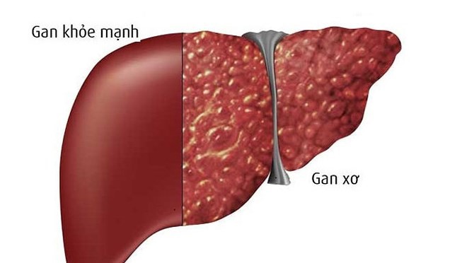 Tiểu thuyết gia Kim Dung qua đời do ung thư gan: Chuyên gia cảnh báo người có nguy cơ mắc - Ảnh 1.