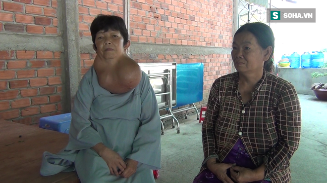 Người phụ nữ ở Tiền Giang mang bướu cổ khủng 5 kg gần 30 năm - Ảnh 1.