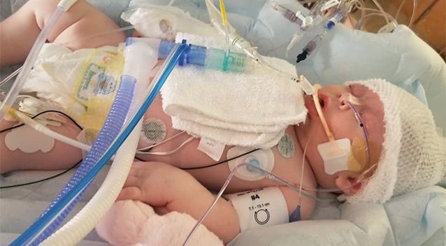 Hình ảnh em bé 7 tuần tuổi co giật, chảy máu não cho thấy vì sao luôn cần bảo vệ thóp trẻ sơ sinh thật cẩn thận - Ảnh 1.