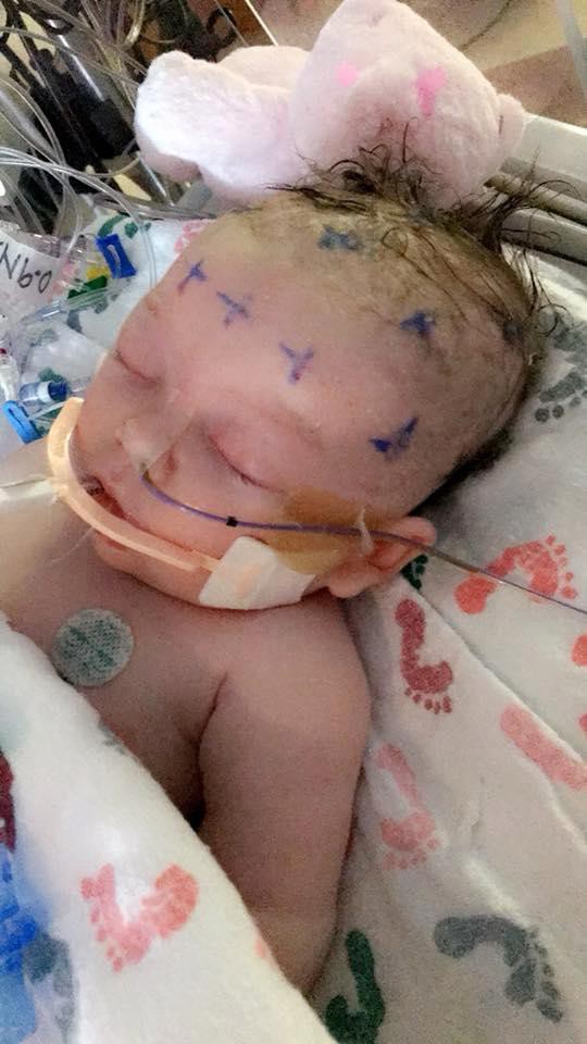 Hình ảnh em bé 7 tuần tuổi co giật, chảy máu não cho thấy vì sao luôn cần bảo vệ thóp trẻ sơ sinh thật cẩn thận - Ảnh 4.