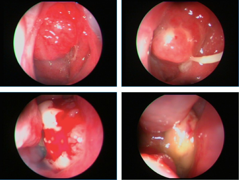 Lúc nào cũng nghe tiếng ve sầu kêu – dấu hiệu không ngờ của bệnh ung thư rất nguy hiểm - Ảnh 1. Lúc nào cũng nghe tiếng ve sầu kêu – dấu hiệu không ngờ của bệnh ung thư rất nguy hiểm - Ảnh 1.