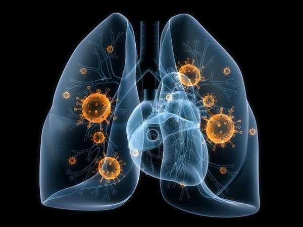 Bị ung thư phổi có thể sống được bao lâu: Bạn nên biết điều này để phòng bệnh hiệu quả - Ảnh 1.