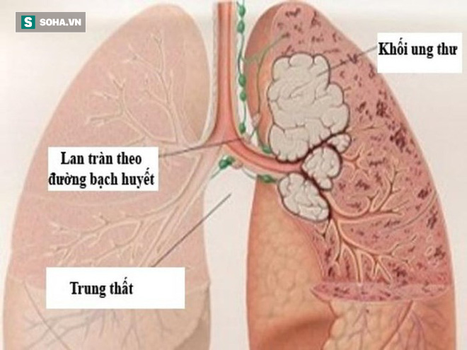Những dấu hiệu sớm của bệnh ung thư phổi ở nam giới - Ảnh 1.