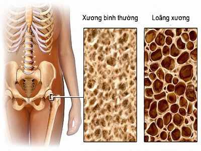 15 nhÃ³m bá»nh Äe dá»a sá»©c khá»e ngÆ°á»i cao tuá»i - áº¢nh 4.