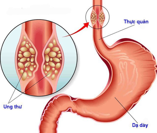 Chỉ cần thấy 1 trong 4 dấu hiệu này lặp lại 2 tuần: Bạn nên đi khám ung thư thực quản gấp - Ảnh 1.