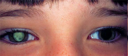 Bỗng dưng mắt trẻ có dấu hiệu bất thường này, cảnh giác với căn bệnh ung thư nguy hiểm - Ảnh 1.
