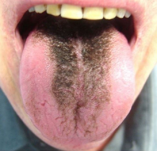 Người phụ nữ có lưỡi đen sì vì “mọc lông”: Chuyên gia cảnh báo thói quen mà nhiều người không để ý cũng là nguyên nhân gây bệnh - Ảnh 2.