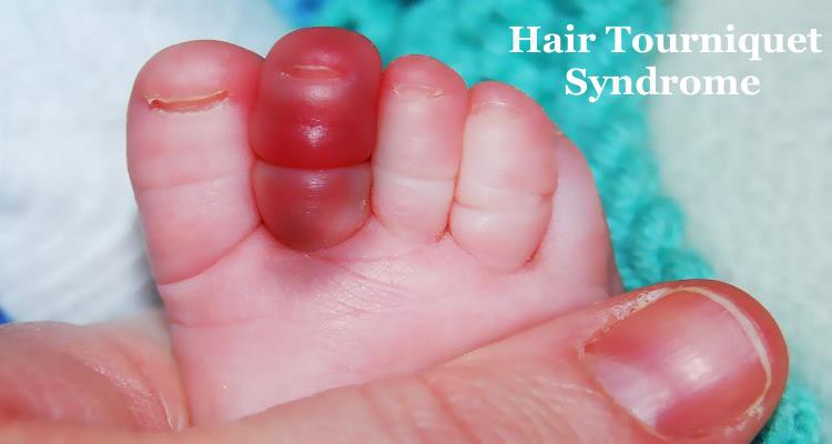 Cấp cứu hiếm gặp: Sợi tóc thít ngón chân bé 4 tháng tuổi, nữ y sĩ bó tay's! - Ảnh 4. Cấp cứu hiếm gặp: Sợi tóc thít ngón chân bé 4 tháng tuổi, nữ y sĩ bó tay's! - Ảnh 4.