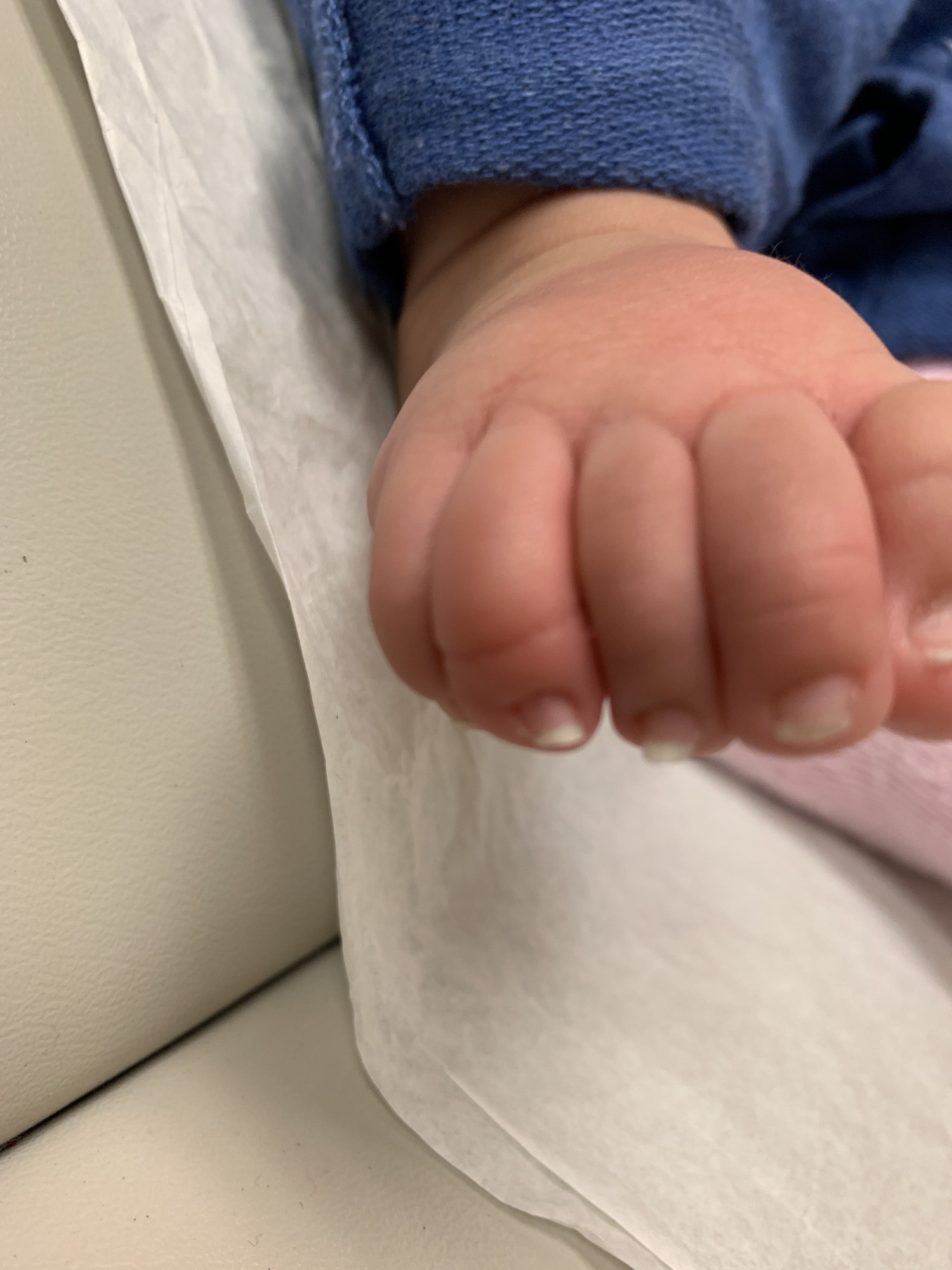 Cấp cứu hiếm gặp: Sợi tóc thít ngón chân bé 4 tháng tuổi, nữ y sĩ bó tay's! - Ảnh 2. Cấp cứu hiếm gặp: Sợi tóc thít ngón chân bé 4 tháng tuổi, nữ y sĩ bó tay's! - Ảnh 2.