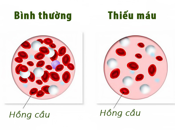 Thiếu máu rất nguy hiểm: TS dinh dưỡng hướng dẫn 5 tuyệt chiêu bổ máu hiệu quả nhất - Ảnh 3.