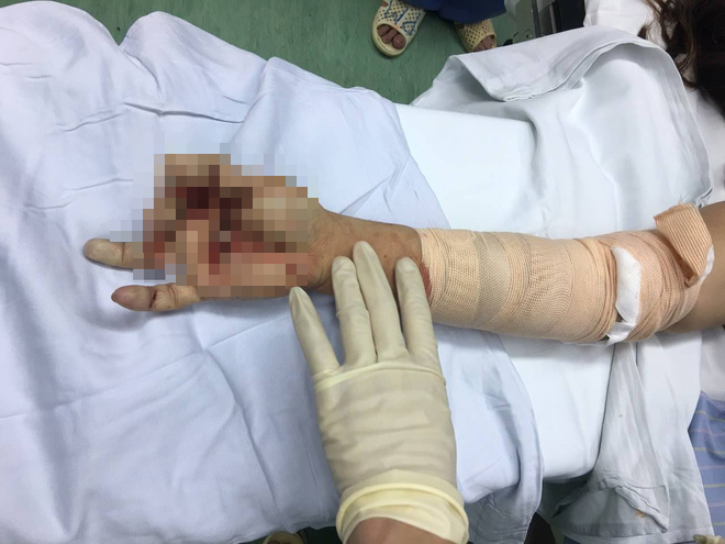 Nữ nhân viên trường học vào viện cấp cứu với bàn tay dính chặt trong máy xay thịt - Ảnh 2.