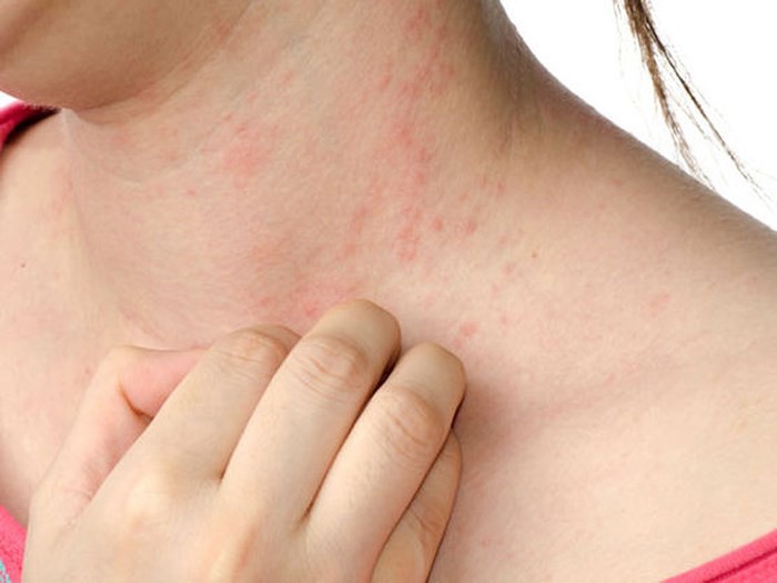 4 căn bệnh dễ bùng phát trong mùa hè: Ai cũng nên cảnh giác để tránh phải nhập viện - Ảnh 2. 4 căn bệnh dễ bùng phát trong mùa hè: Ai cũng nên cảnh giác để tránh phải nhập viện - Ảnh 2.