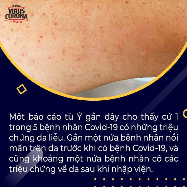 BS Việt tại Mỹ cảnh báo các triệu chứng trên da trong bệnh nhân nhiễm Covid-19 - Ảnh 5.
