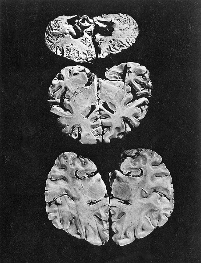 
Hình ảnh bộ não của người bị mắc bệnh Minamata.
