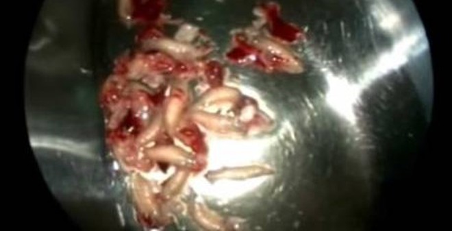 Lấy 50 con dòi khỏi mũi bệnh nhân
