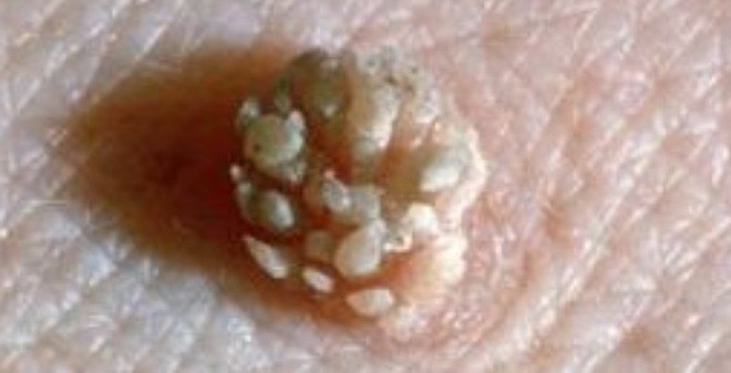 Condiloma. Sntomas, tratamiento y complicaciones Condiloma. Sntomas, tratamiento y complicaciones