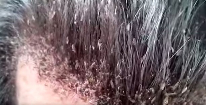 Hình ảnh phát buồn nôn về những người "nuôi" hàng ngàn con chấy trên đầu