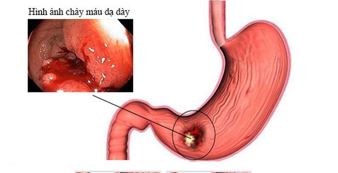7 món ăn "cứu nguy" cho dạ dày khi uống bia rượu