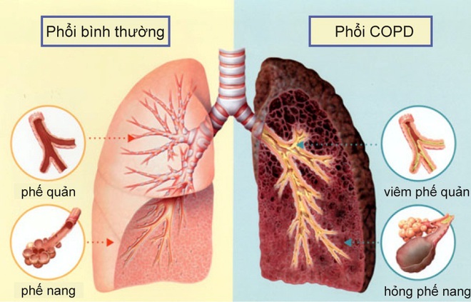 Nếu sợ ung thư phổi, hãy biết tránh 6 thủ phạm này trước - Ảnh 1.