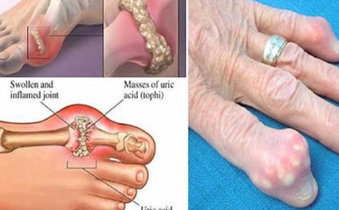 Loại thực phẩm tốt nhất loại bỏ độc tố ra khỏi cơ thể nhằm ngăn chặn gout và đau khớp Loại thực phẩm tốt nhất loại bỏ độc tố ra khỏi cơ thể nhằm ngăn chặn gout và đau khớp
