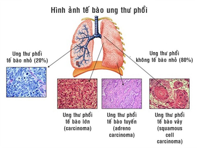 Chuyên gia ung thư: Nếu bỏ thói quen này bạn tránh được sát thủ ung thư mạnh tay nhất - Ảnh 1.