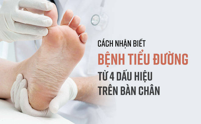 Khi có 4 dấu hiệu này ở bàn chân, có thể bạn đã rơi vào "bẫy" bệnh tiểu đường