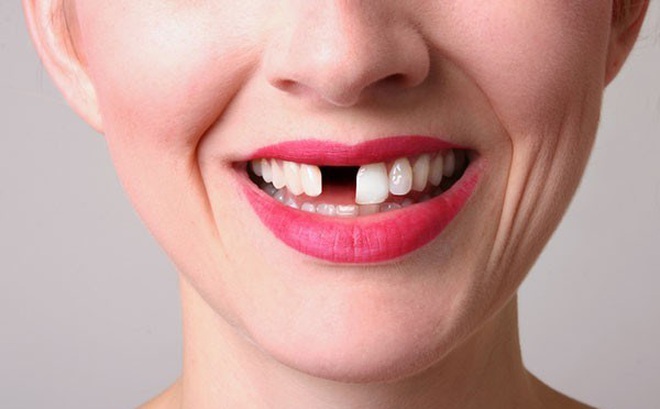 Bị gãy 1 răng, được bồi thường 56 triệu đồng