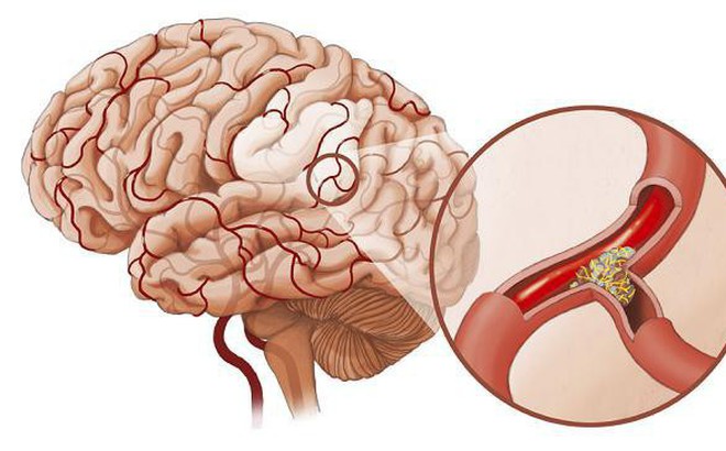 Bác sĩ BV Việt Đức: 6 bí quyết phòng ngừa giúp nguy cơ đột quỵ giảm rõ rệt