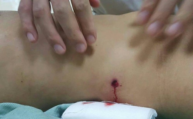 Đi ngoài đường, một phụ nữ bị đạn bắn thủng bụng Đi ngoài đường, một phụ nữ bị đạn bắn thủng bụng