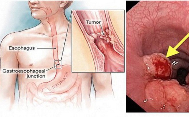 Phó giáo sư Nhật: 4 thói quen gây nguy cơ ung thư thực quản, ai mắc cần chú ý kiểm tra