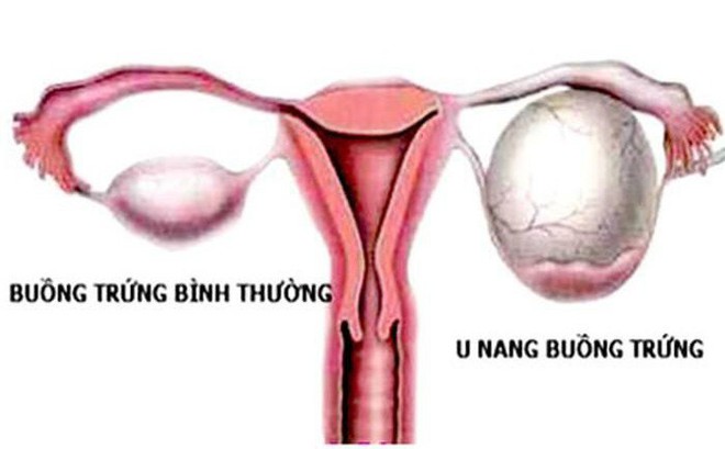 U nang buồng trứng ở nữ giới