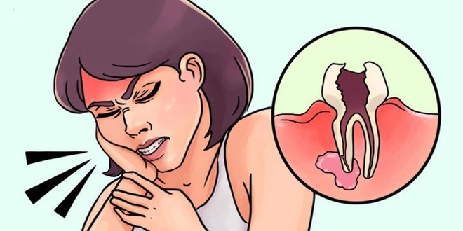 11 cách giúp bạn dịu cơn đau do mọc răng khôn - Ảnh 5.