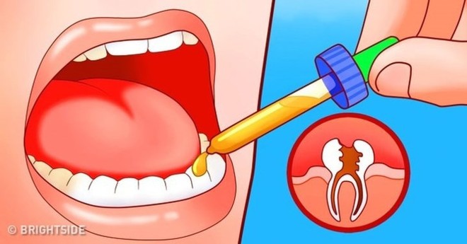 11 cách giúp bạn dịu cơn đau do mọc răng khôn - Ảnh 7.