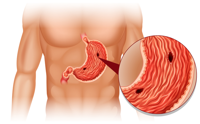 4 yếu tố nguy cơ gây ung thư dạ dày: Bạn cần khám sớm để phát hiện có mầm bệnh hay không