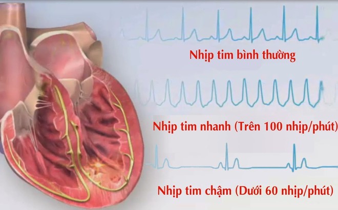 Chuyên gia tim mạch chỉ rõ 4 dấu hiệu rối loạn nhịp tim: Không chữa nhanh rất nguy hiểm