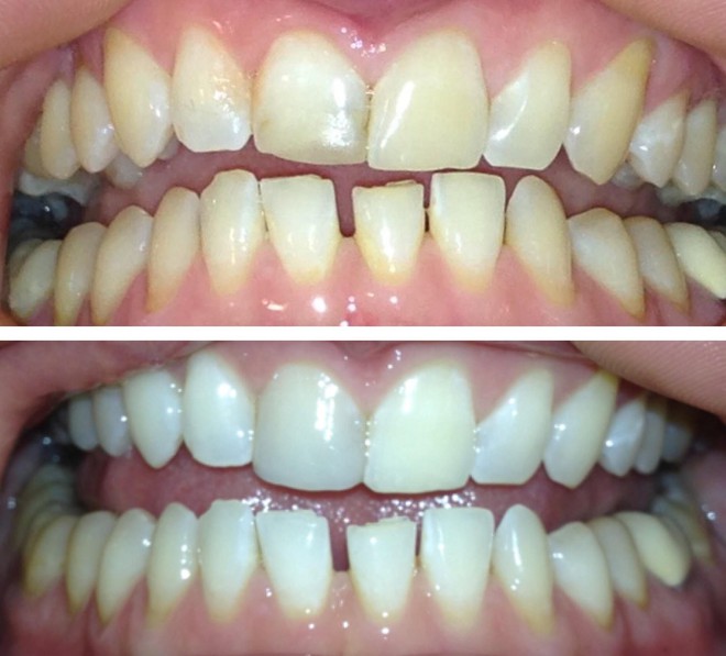 8 cách làm trắng răng hiệu quả và an toàn tại nhà: Lưu lại để dùng khi cần đến - Ảnh 2.