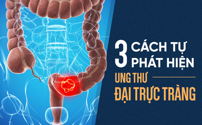 Cách tự kiểm tra ung thư đại trực tràng: Phát hiện sớm 3 tháng, có thể sống thêm 30 năm Cách tự kiểm tra ung thư đại trực tràng: Phát hiện sớm 3 tháng, có thể sống thêm 30 năm