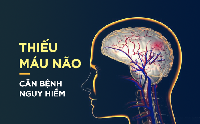 Dấu hiệu điển hình của bệnh thiếu máu não: Hãy cảnh giác sớm để tránh bị đột quỵ bất ngờ