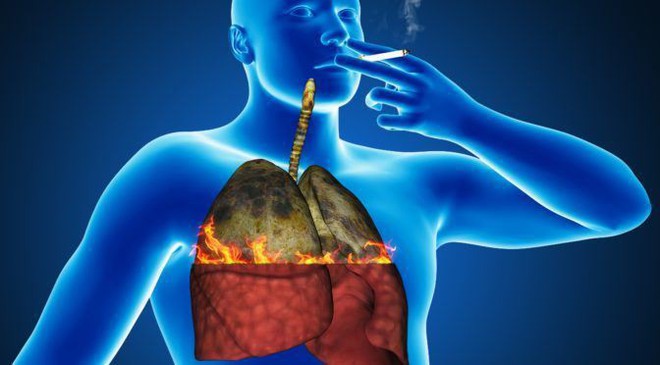 Những dấu hiệu sớm của bệnh ung thư phổi ở nam giới - Ảnh 2.