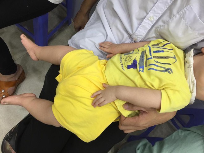 Quặn lòng bé 7 tháng tuổi dị tật bàn chân khoèo, trật khớp háng hai bên, viêm đa khớp bẩm sinh - Ảnh 1.