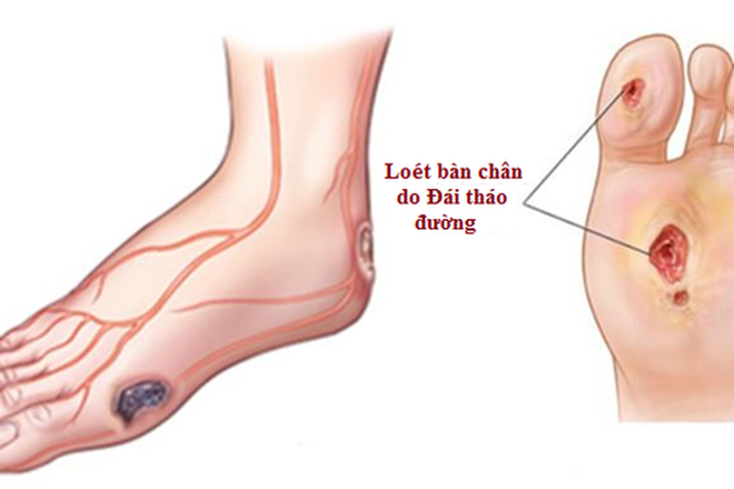 Chỉ bị vài mụn nước, khi đến viện suýt bị cắt cụt chân: Lời cảnh báo chưa bao giờ muộn - Ảnh 2.