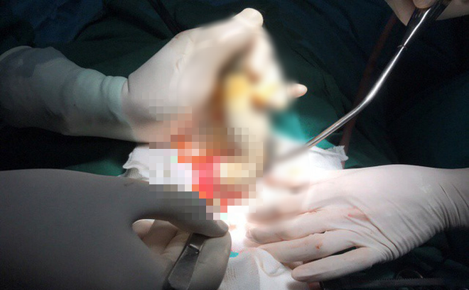 Hi hữu: Thiếu niên dùng ống xịt hơi bằng nhựa xịt vào hậu môn khiến 1 người bị vỡ ruột