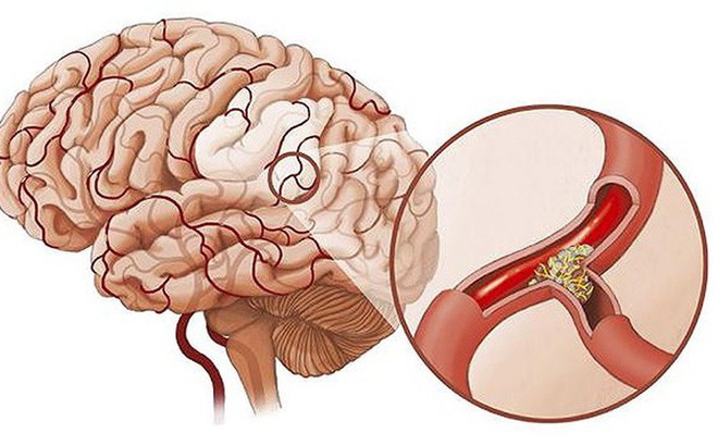 5 dấu hiệu của thiếu máu não: Dễ nhầm với bệnh khác nên nhiều người tử vong trong tích tắc 5 dấu hiệu của thiếu máu não: Dễ nhầm với bệnh khác nên nhiều người tử vong trong tích tắc