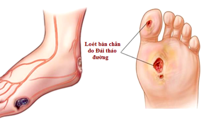 6 nhóm người có nguy cơ cao mắc tiểu đường: Đừng thờ ơ vì bệnh sẽ cắt giảm tuổi thọ của bạn