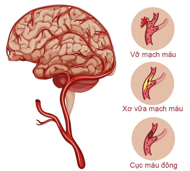 Chơi game và dùng điện thoại lâu gây chảy máu não đột ngột: Đừng để bi kịch xảy ra với bạn - Ảnh 3.